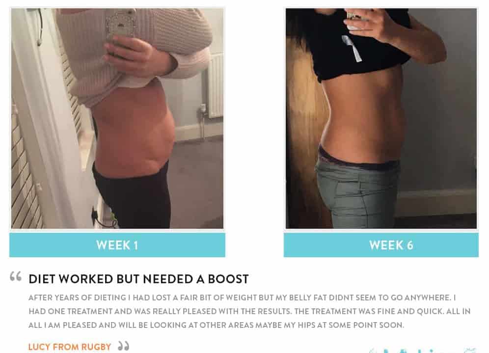 Before and After Dieting Avonmouth