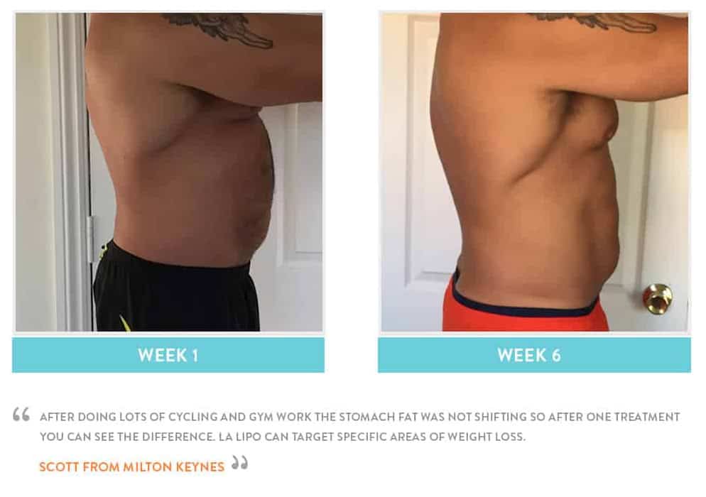 Before & After Stomach Fat Avonmouth