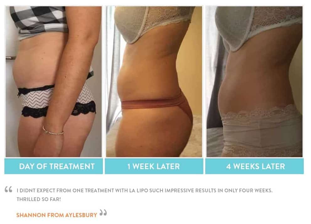 before, Cryolipolysis Avonmouth