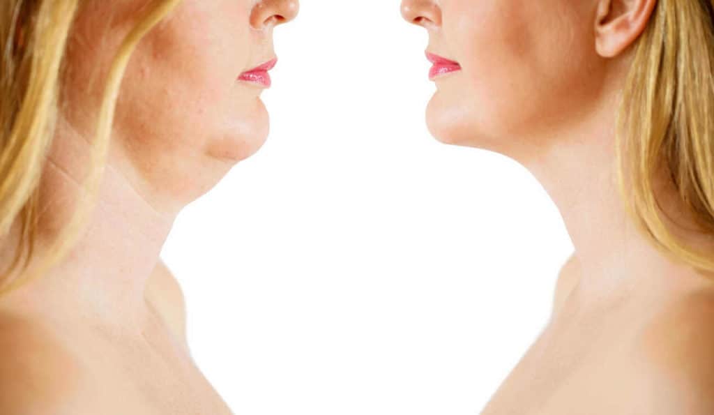 Double Chin treatment Avonmouth before and after results