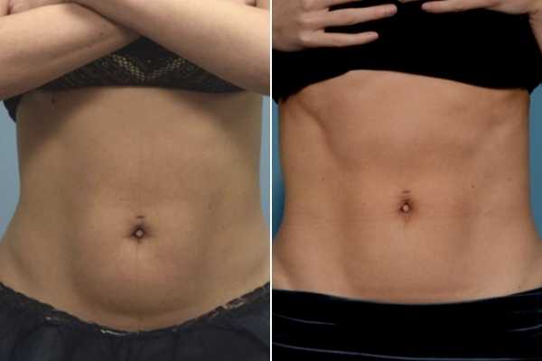 body sculpting FAQs Avonmouth