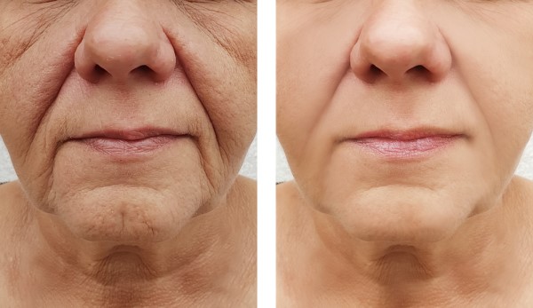 Learn more about Morpheus8 Treatment Avonmouth today!