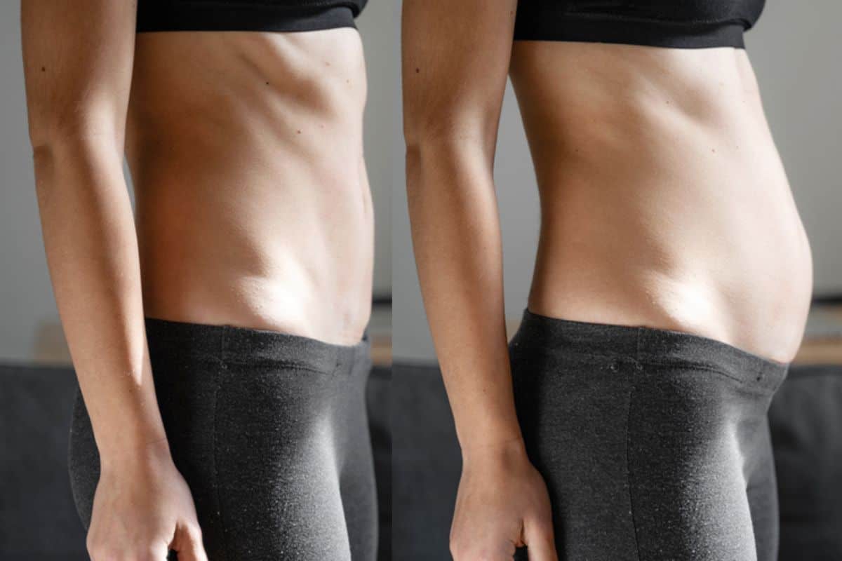 How long does diastasis recti take to improve Avonmouth?