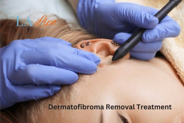 Dermatofibroma Removal Treatment Avonmouth