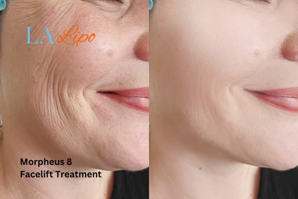 Morpheus8 Treatment Avonmouth for flawless skin! Call us today!