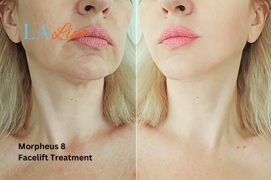 Turn back time with Morpheus8 Treatment Avonmouth