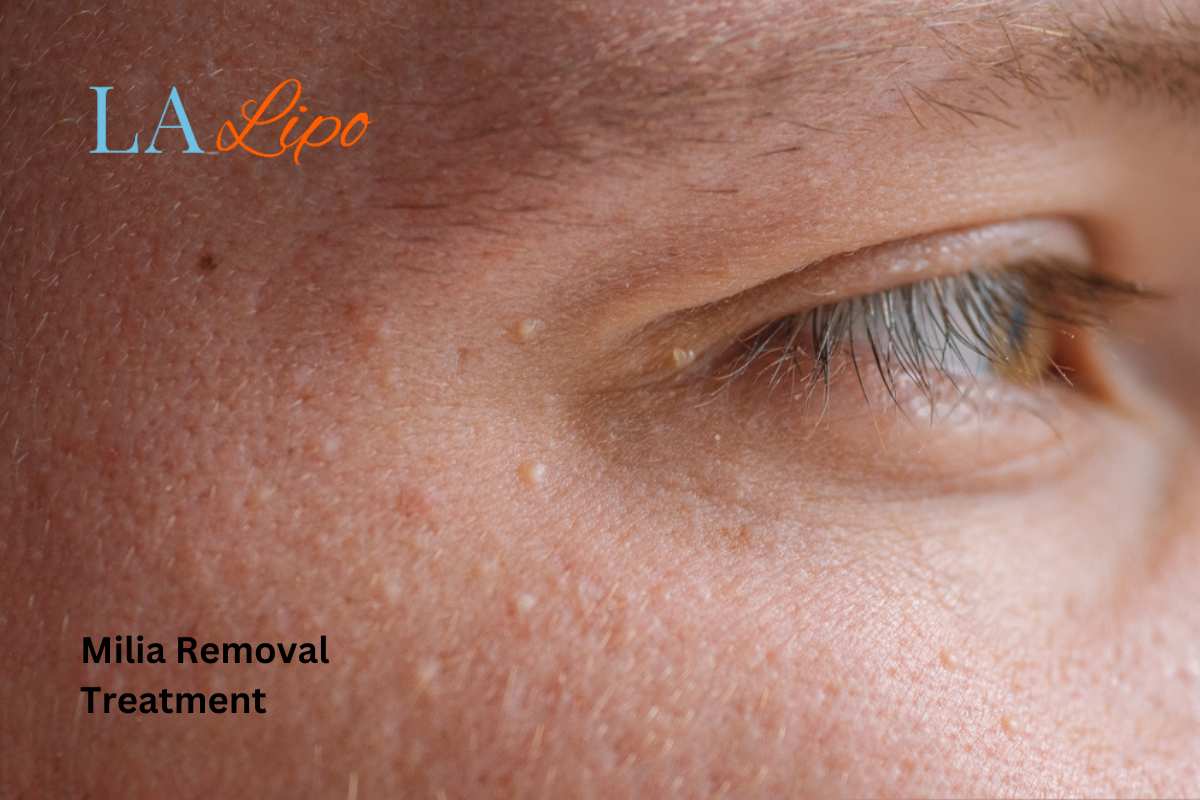 Cryopen Milia Removal: Is It the Easiest and Safest Option Avonmouth?