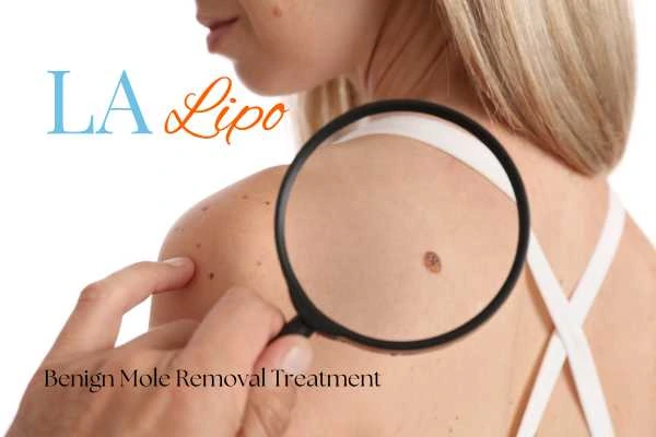 Woman having her inspection of blemish before mole removal Avonmouth