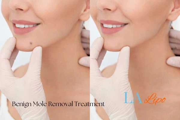 Before and after mole removal Avonmouth treatment