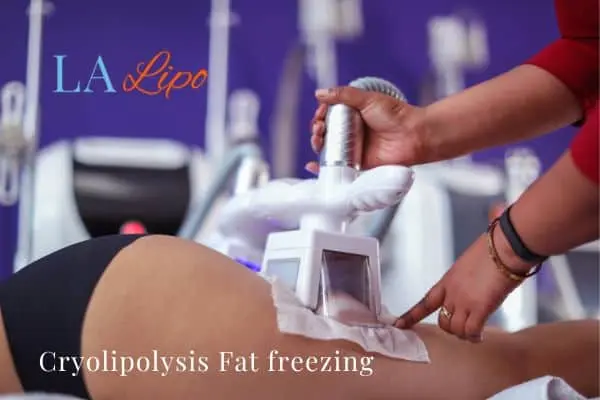 women getting fat freezing Avonmouth