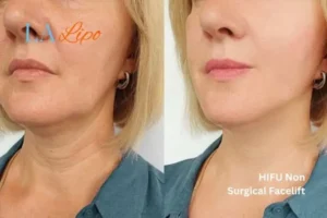 hi-fu for wrinkles Avonmouth before and after results