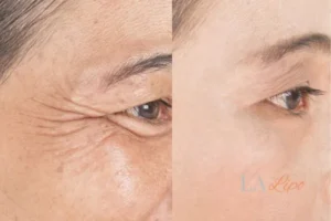 Before and after results of woman - HI-fu wrinkles reduction treatment Avonmouth