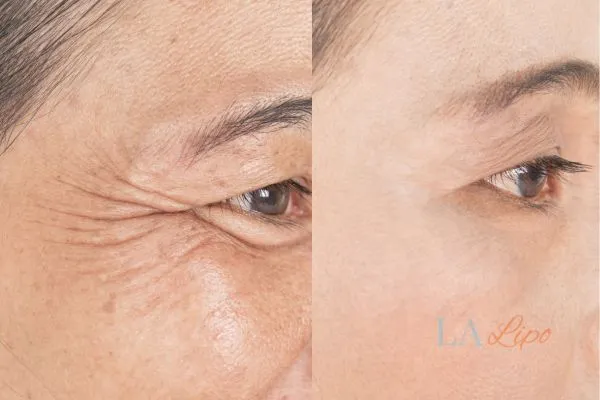 Before and after results of woman - HI-fu wrinkles reduction treatment Avonmouth