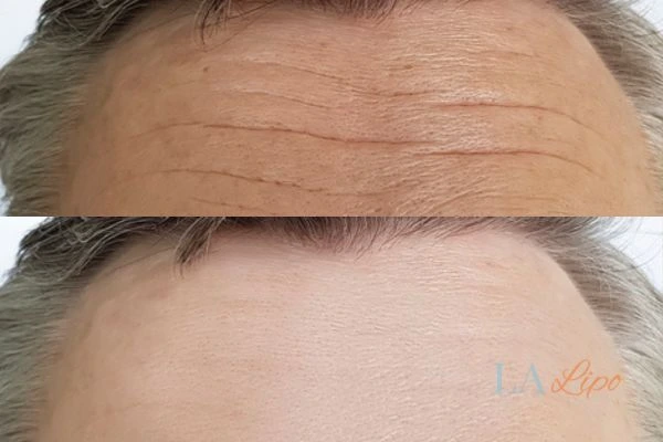 results of HIFU Avonmouth on mans forehead to help reduce lines and wrinkles
