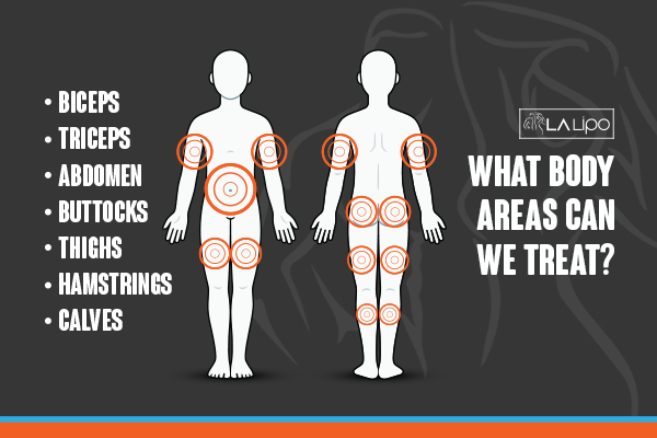 Graphic to show areas you can have LA-EMS Body Sculpting Avonmouth treatment.