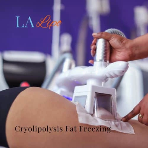 fat freezing - Cryolipolysis Avonmouth