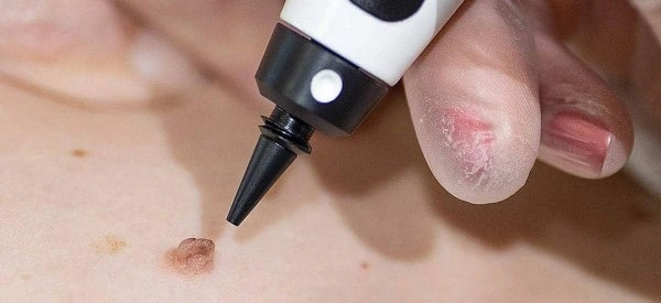 skin tag removal using cryopen Avonmouth