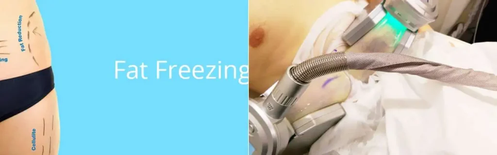 multi areas of a persons body having coolsculpting Avonmouth treatment