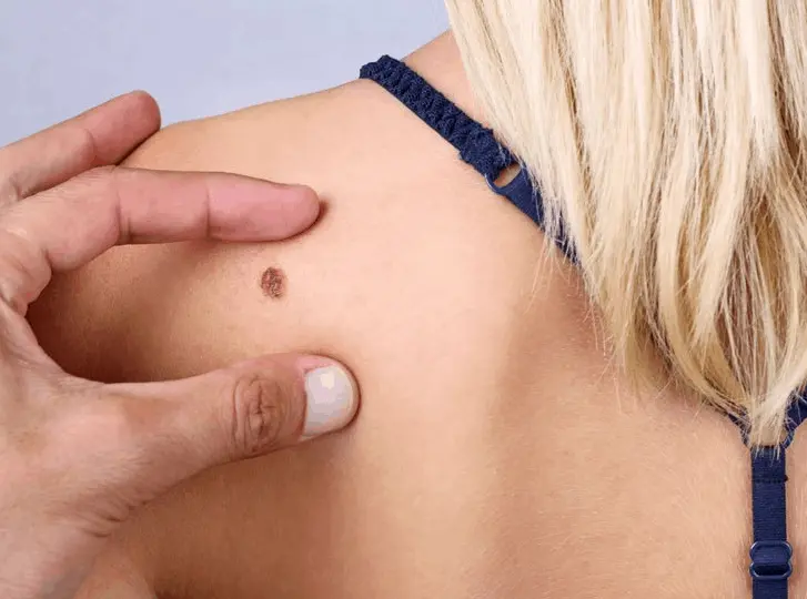woman having mole removal Avonmouth consultation before treatment.