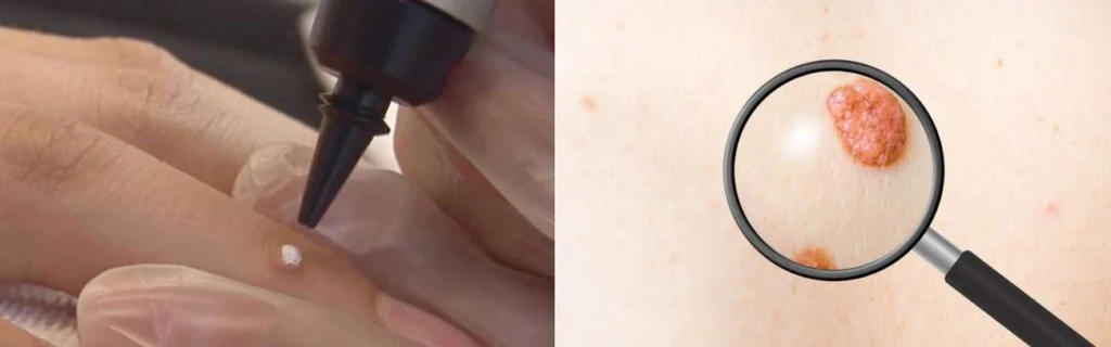 Person getting moles removed with cryopen Avonmouth
