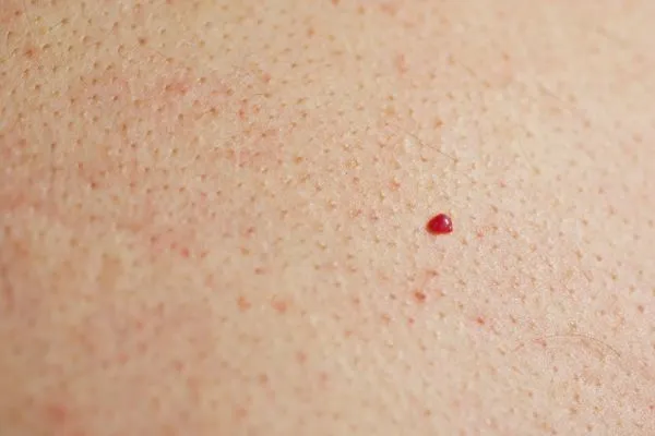 close up of a cherry angioma Avonmouth