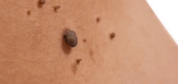 image of a skin tag Avonmouth