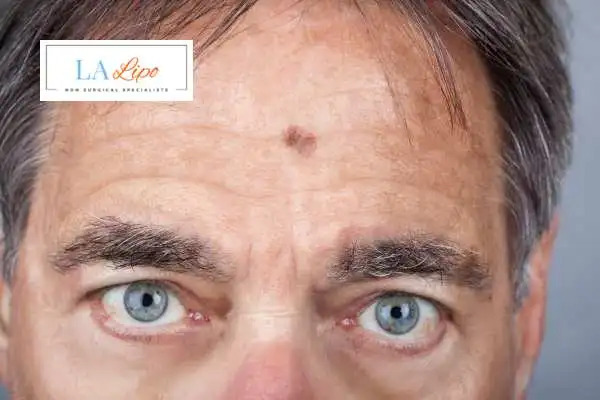 Solar Lentigo Removal Avonmouth image of man with mark on his forehead