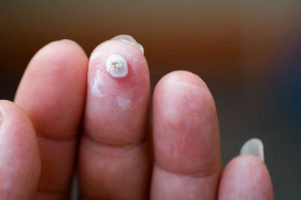 wart on person finger - cryotherapy to treat from LA LIPO Avonmouth