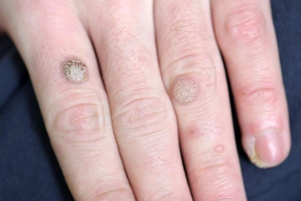 photo of warts on person hand - see wart removal Avonmouth from LA LIPO