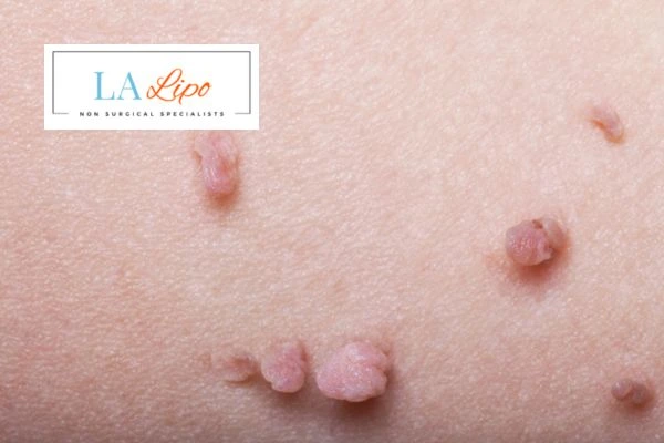 Does cryopen skin tag removal Avonmouth hurt? Find out now call our team today!