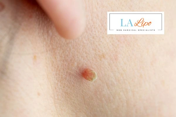 Book skin tag removal Avonmouth today speak to our team now!