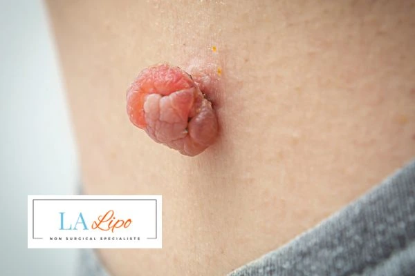 Interested in skin tag removal Avonmouth? Concerned about the pain? Find out more today!