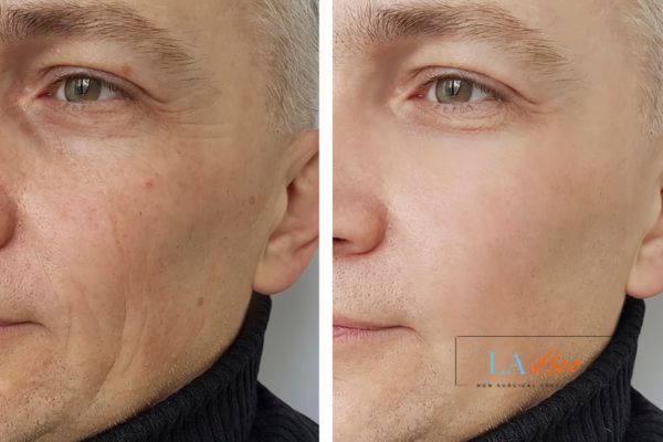 See the amazing results of Morpheus8 Treatment Avonmouth!