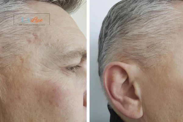 Mens Before & After Morpheus 8 Results Avonmouth