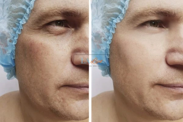Before and after Morpheus 8 Results Avonmouth