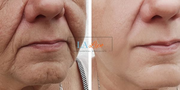 Older lady deeper wrinkle reduction - LA LIPO Morpheus 8 Results Avonmouth