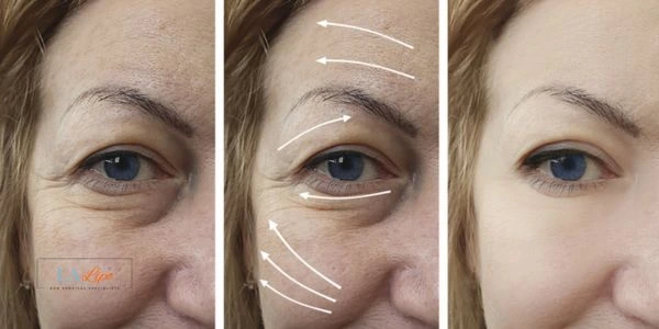 Amazing eye lift Morpheus 8 results Avonmouth