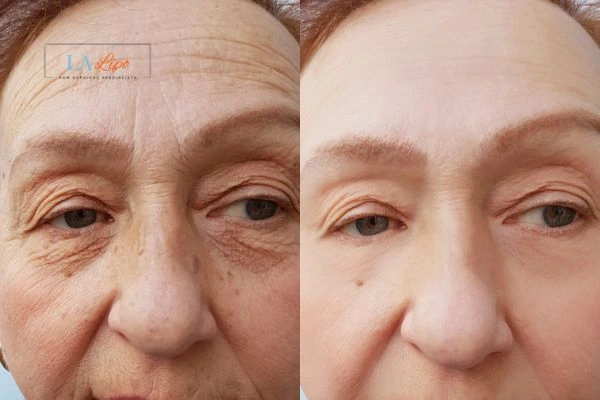 The powerful benefits of Morpheus8 Treatment Avonmouth - Call Our team today!