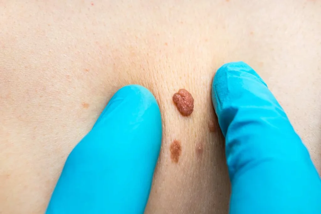 LA LIPO Cryopen Lesion Removal Prices Avonmouth