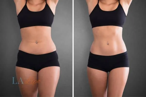 before and after results of non-surgical treatment to help a woman's body image and mental health Avonmouth