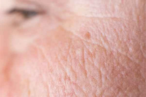 close up picture of a woman's face showing an age spot Avonmouth