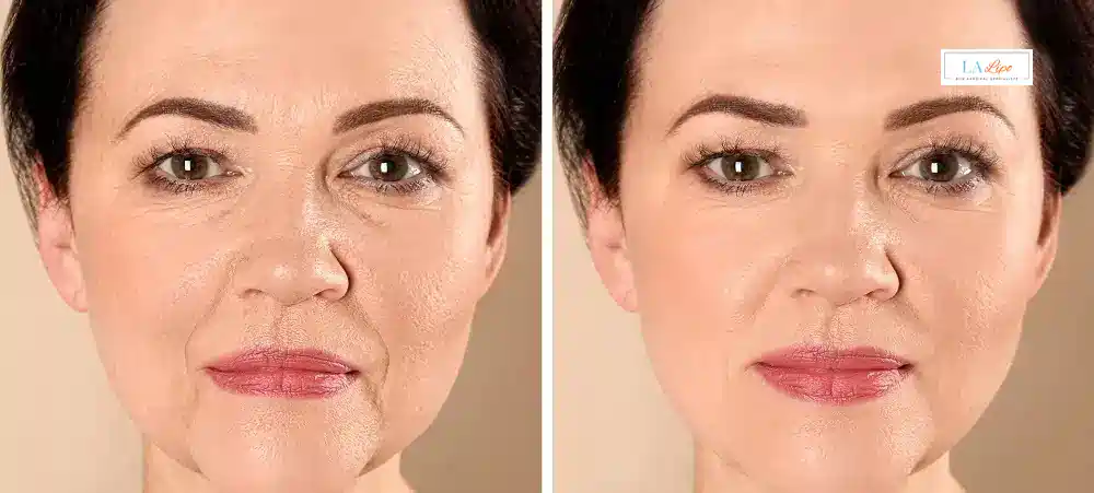 How Long Does It Take to See Results and How Long Do They Last Avonmouth?