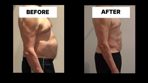 What Symptoms Can Diastasis Recti Cause in Men? Weak Core, Back Pain and Poor Posture Avonmouth